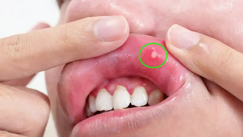 B Vitaminleri Eksikliği: Vücudunuzun Gösterdiği 5 Belirgin Belirti