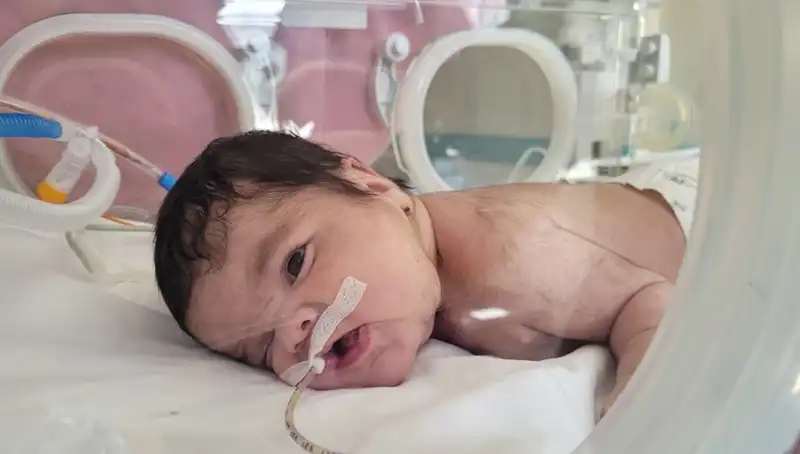 Dünyada Eşine Az Rastlanan Durum: Eymen Bebek Nefes Almaya Başladı!