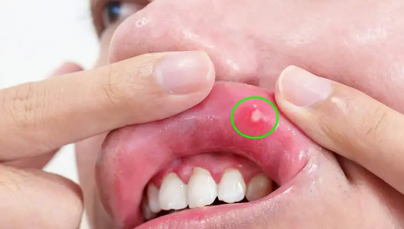Kanserin Gizli Belirtileri: Dilini Kayıp Eden Kişinin Dramı