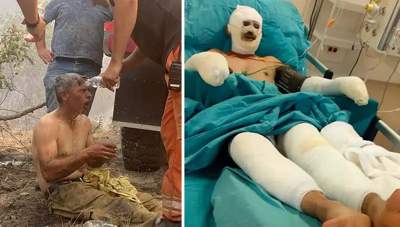 Yanıyorum Diye Feryat Eden Orman İşçisinin Yaşam Mücadelesi Devam Ediyor